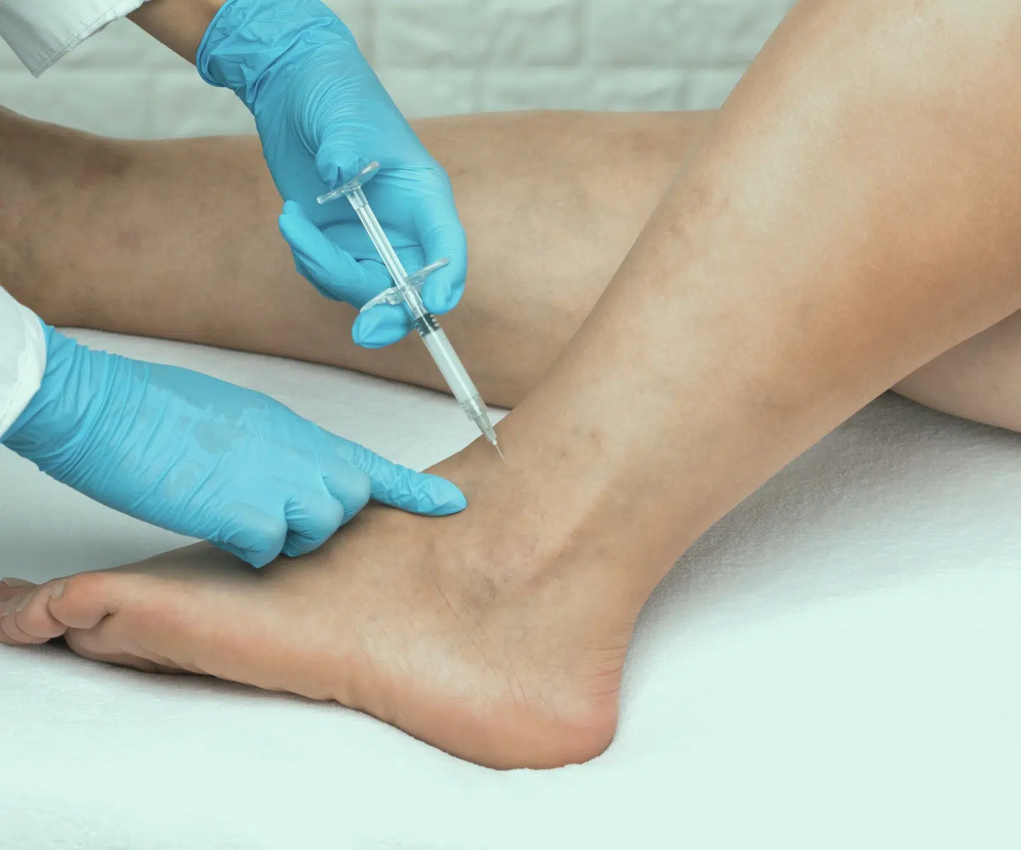 Injection de PRP au niveau de la cheville, tendinopathie de la cheville – IRMI