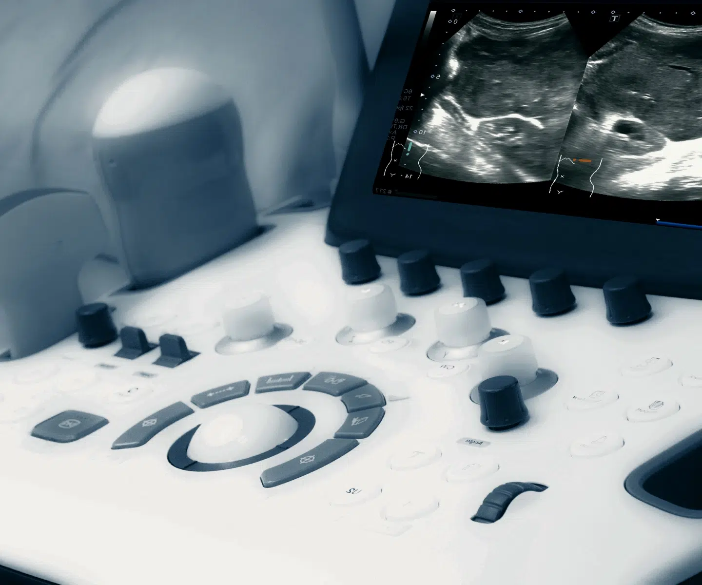 Console d'échographe, embolisation veineuse pelvienne directe – IRMI